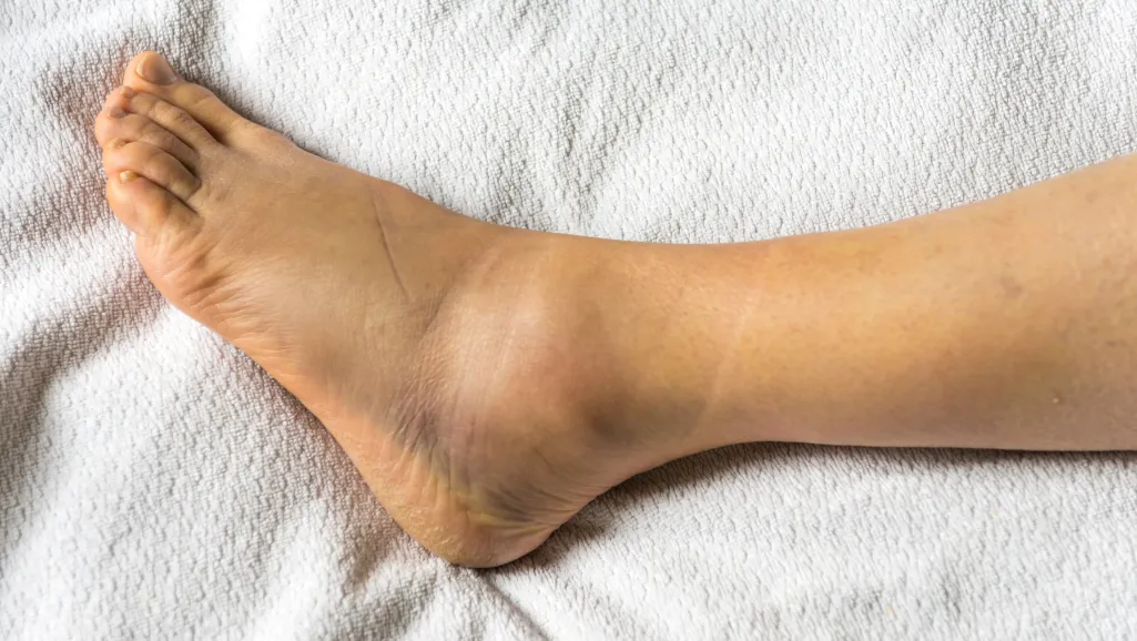Illustration for What to Do If You Suspect a Broken Bone