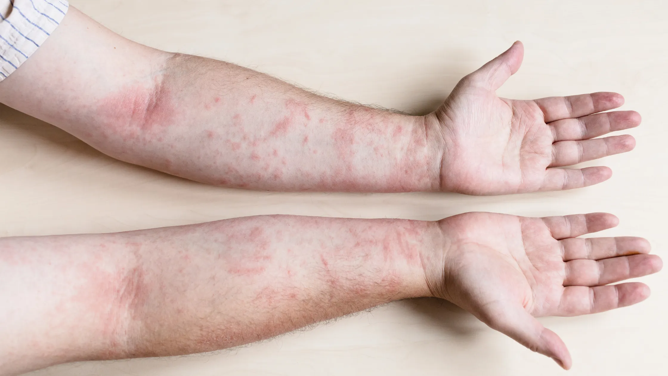 Illustration for Cellulitis: A Guide to Recognizing This Skin Infection