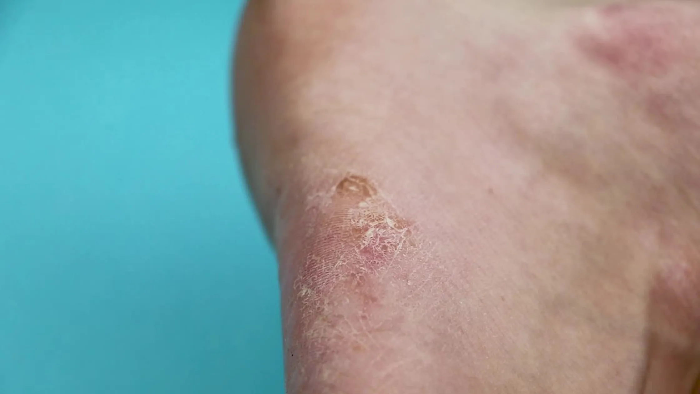Medical illustration 4 - Cellulitis: A Comprehensive Guide to Recognizing and Understanding This Skin Infection