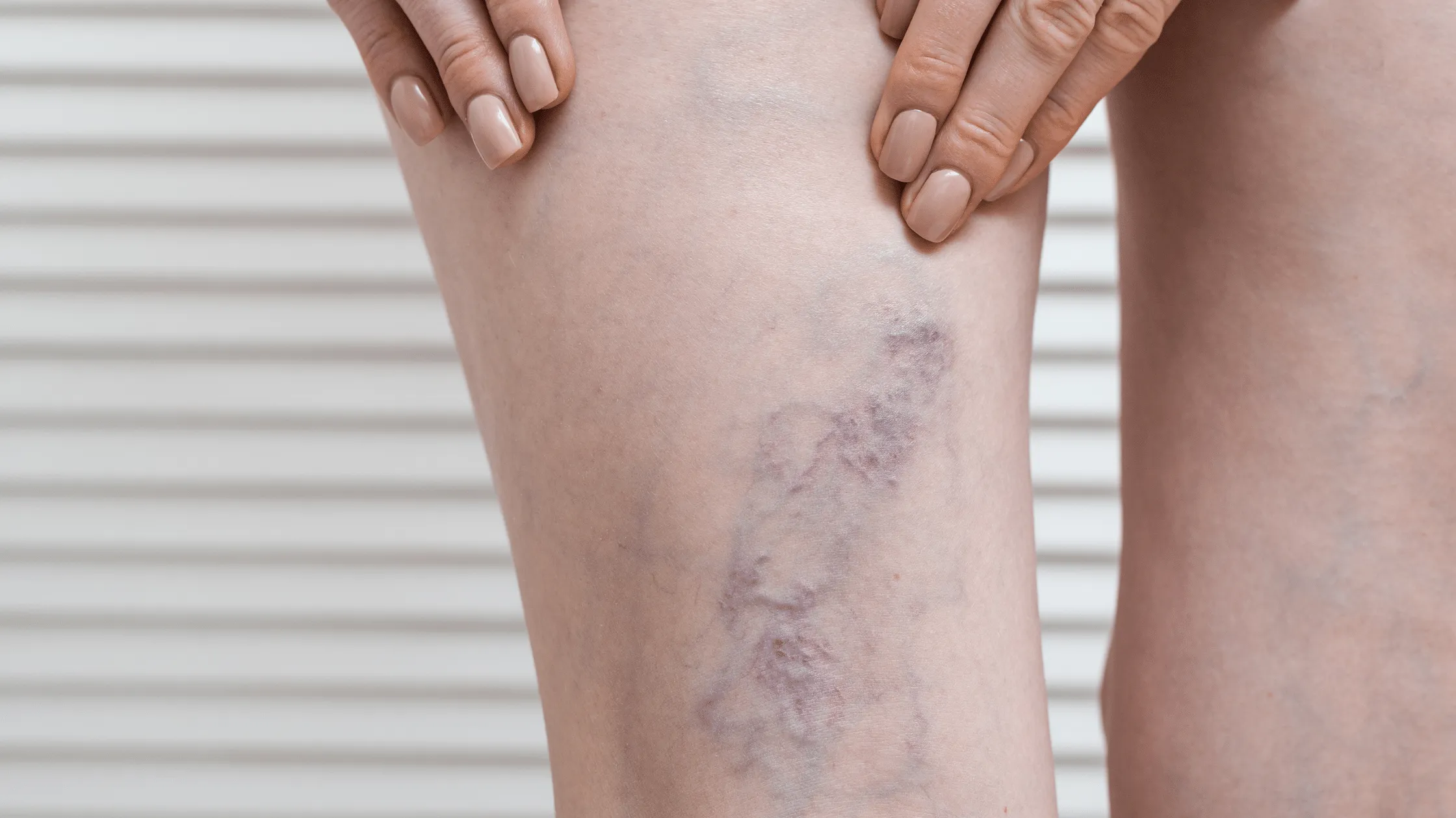 Illustration for \Your Essential Guide to Preventing Cellulitis: Proactive Measures and Tips