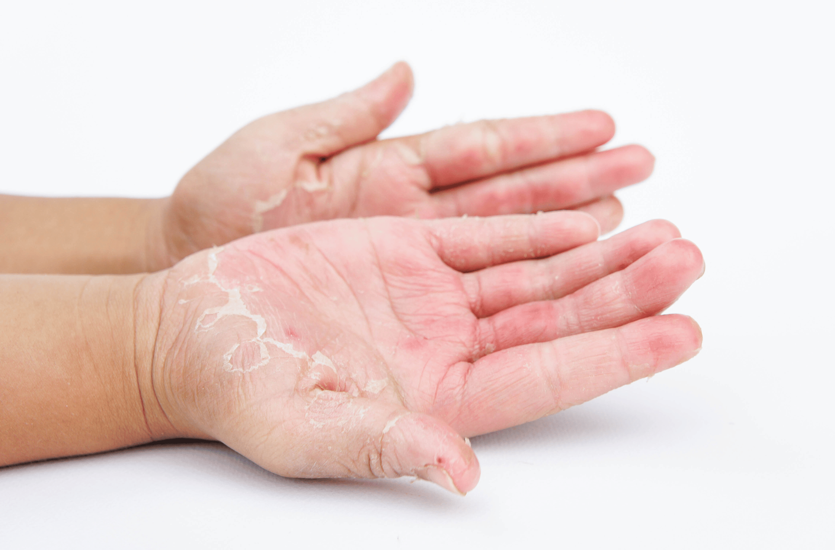 Illustration for Battling Fungal Infections: From Causes to Natural Cures at Bellaire ER