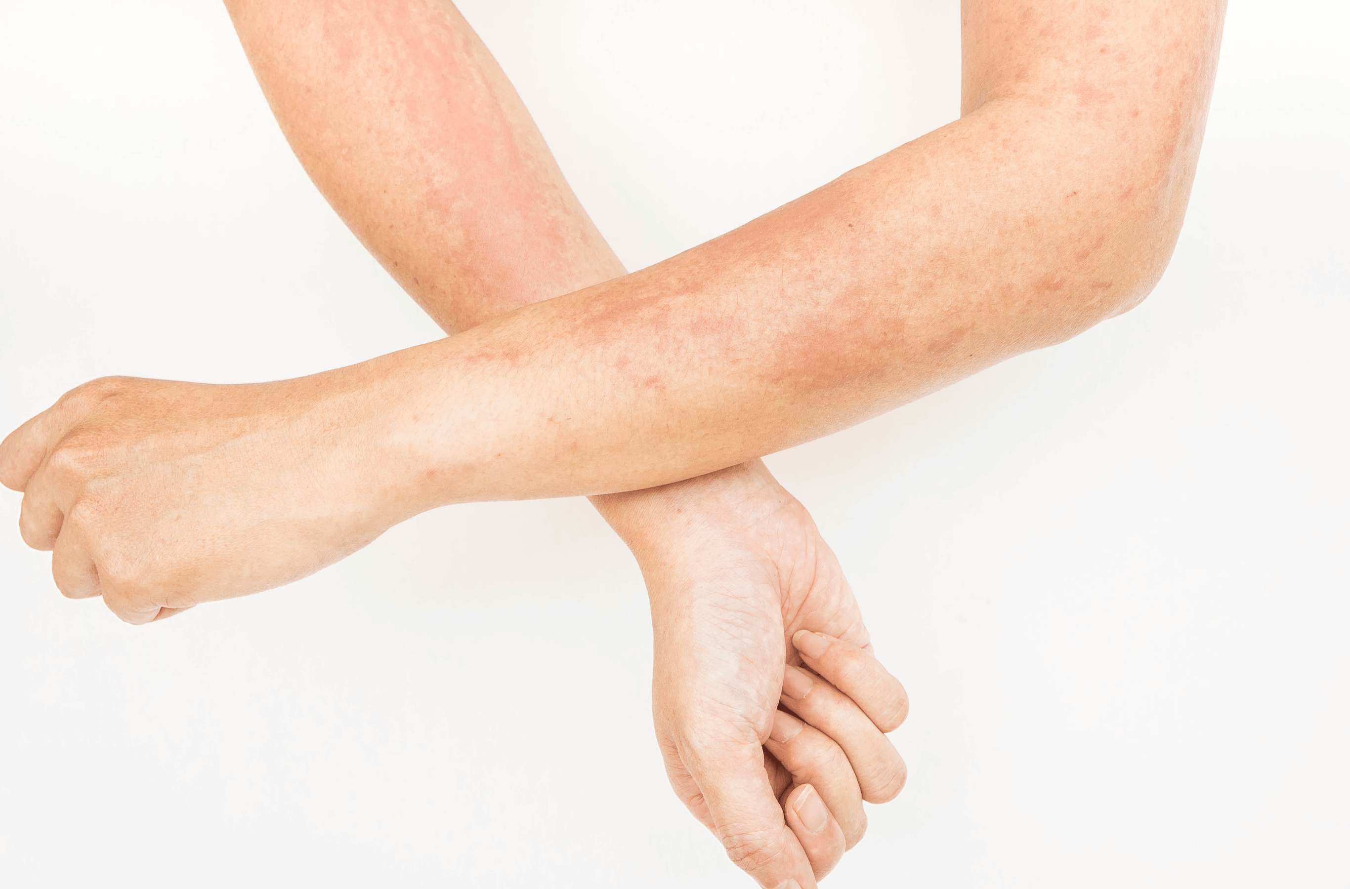 Illustration for Battling Fungal Infections: From Causes to Natural Cures at Bellaire ER