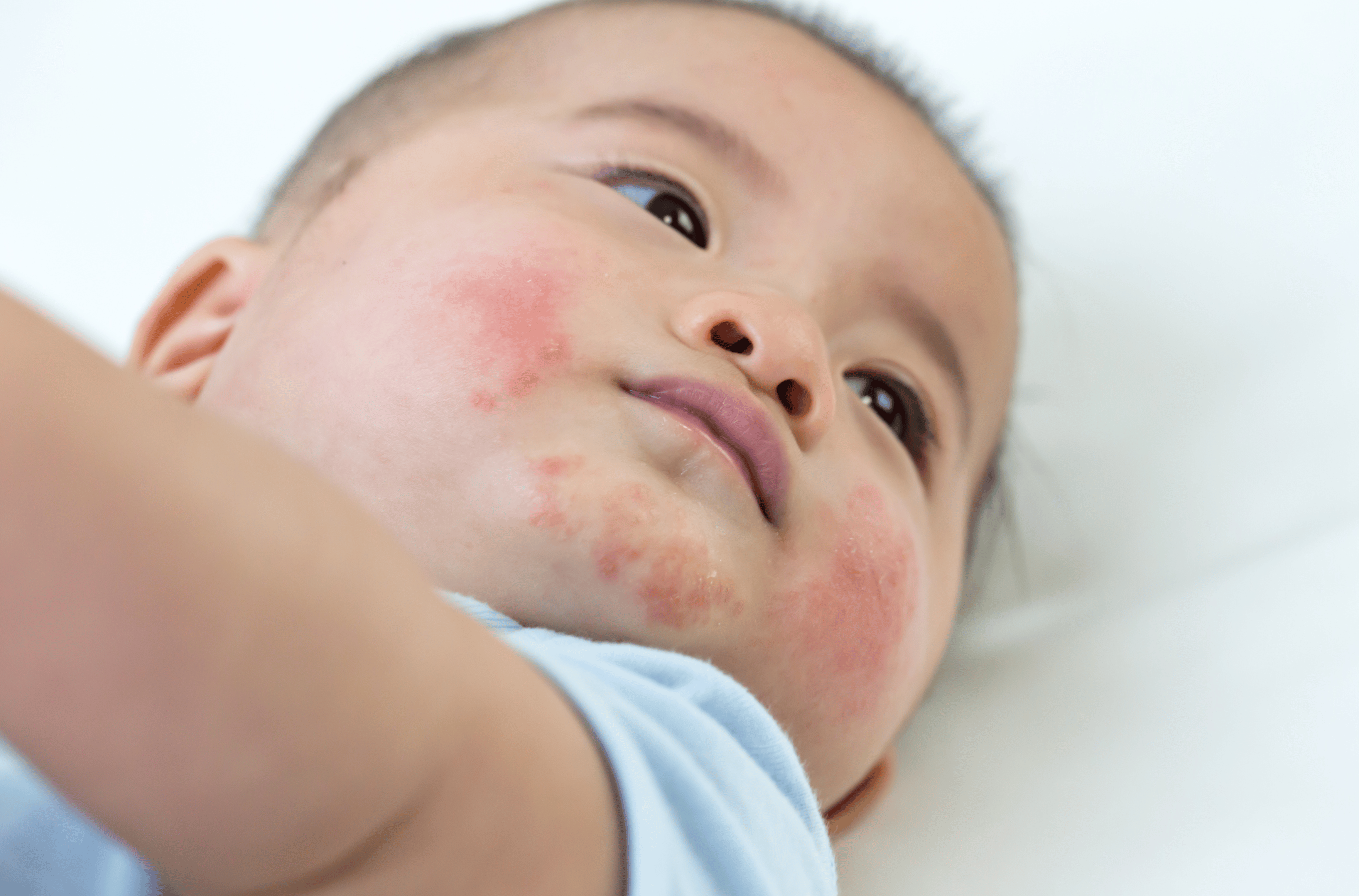 Illustration for Allergic Reactions treatment at Bellaire ER