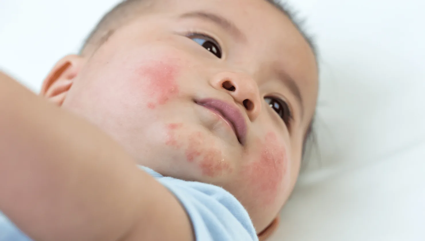 Illustration for Allergic Reactions treatment at Bellaire ER