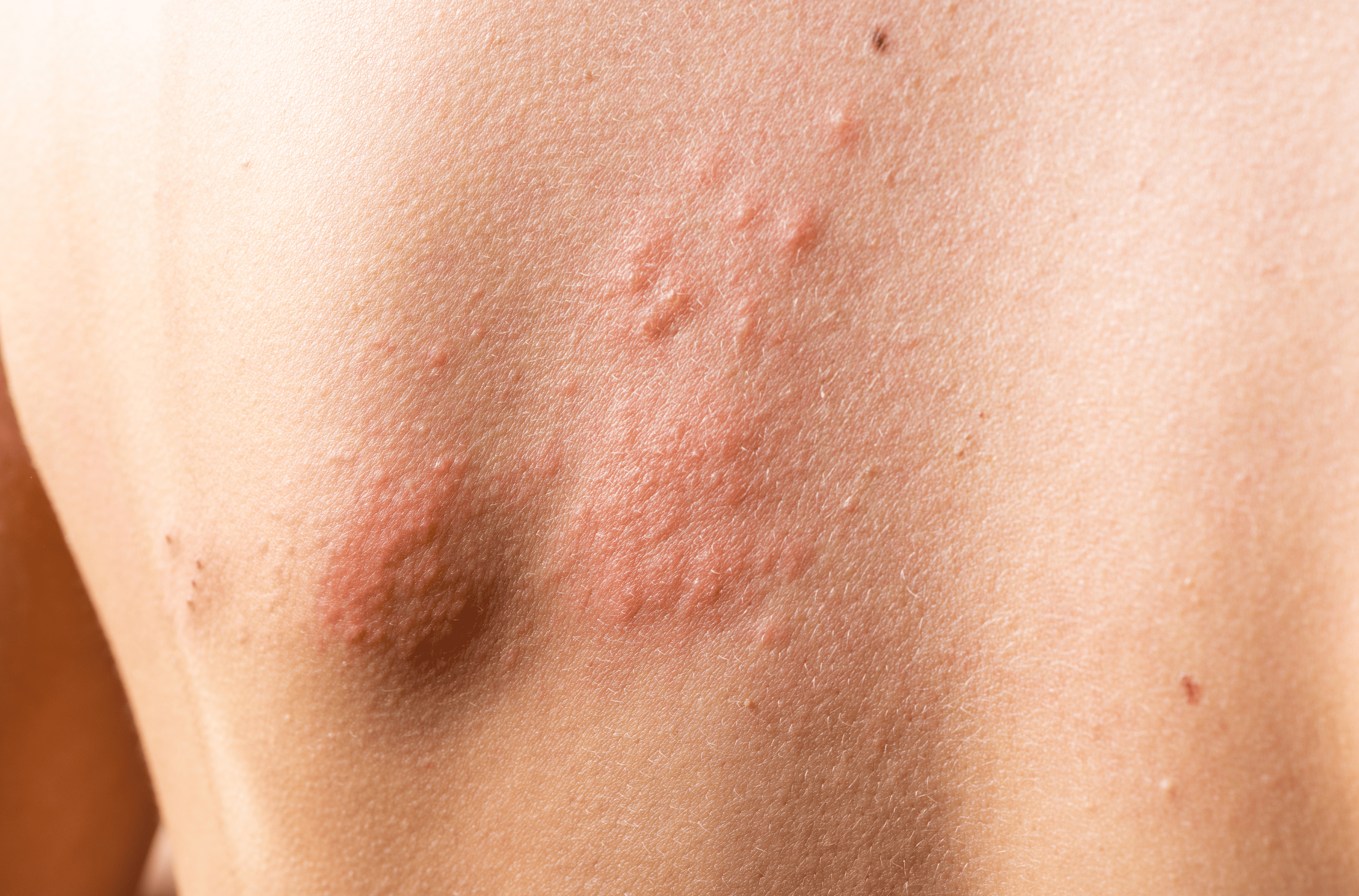 Illustration for Skin Infections treatment at Bellaire ER