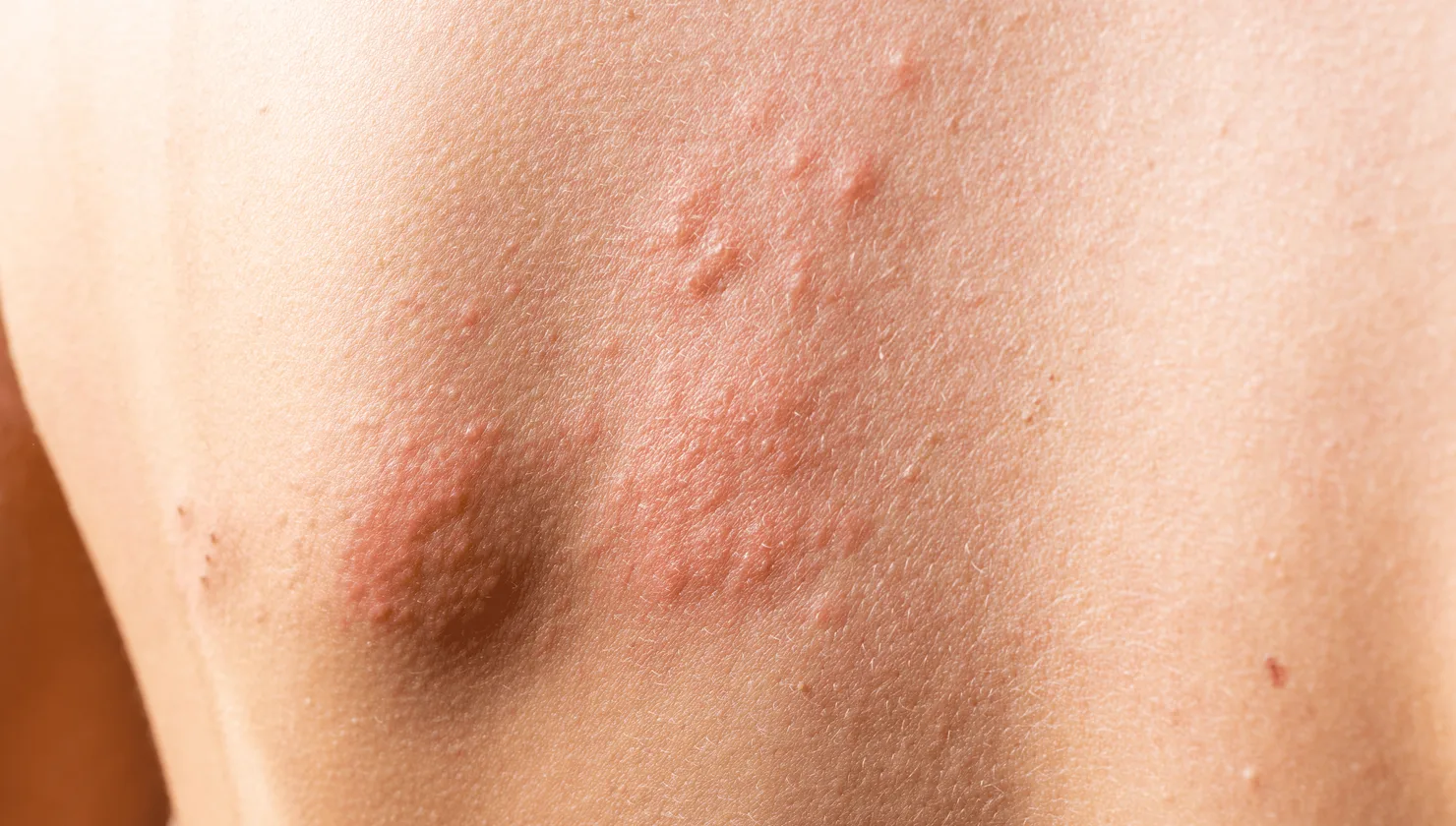 Illustration for Skin Infections treatment at Bellaire ER