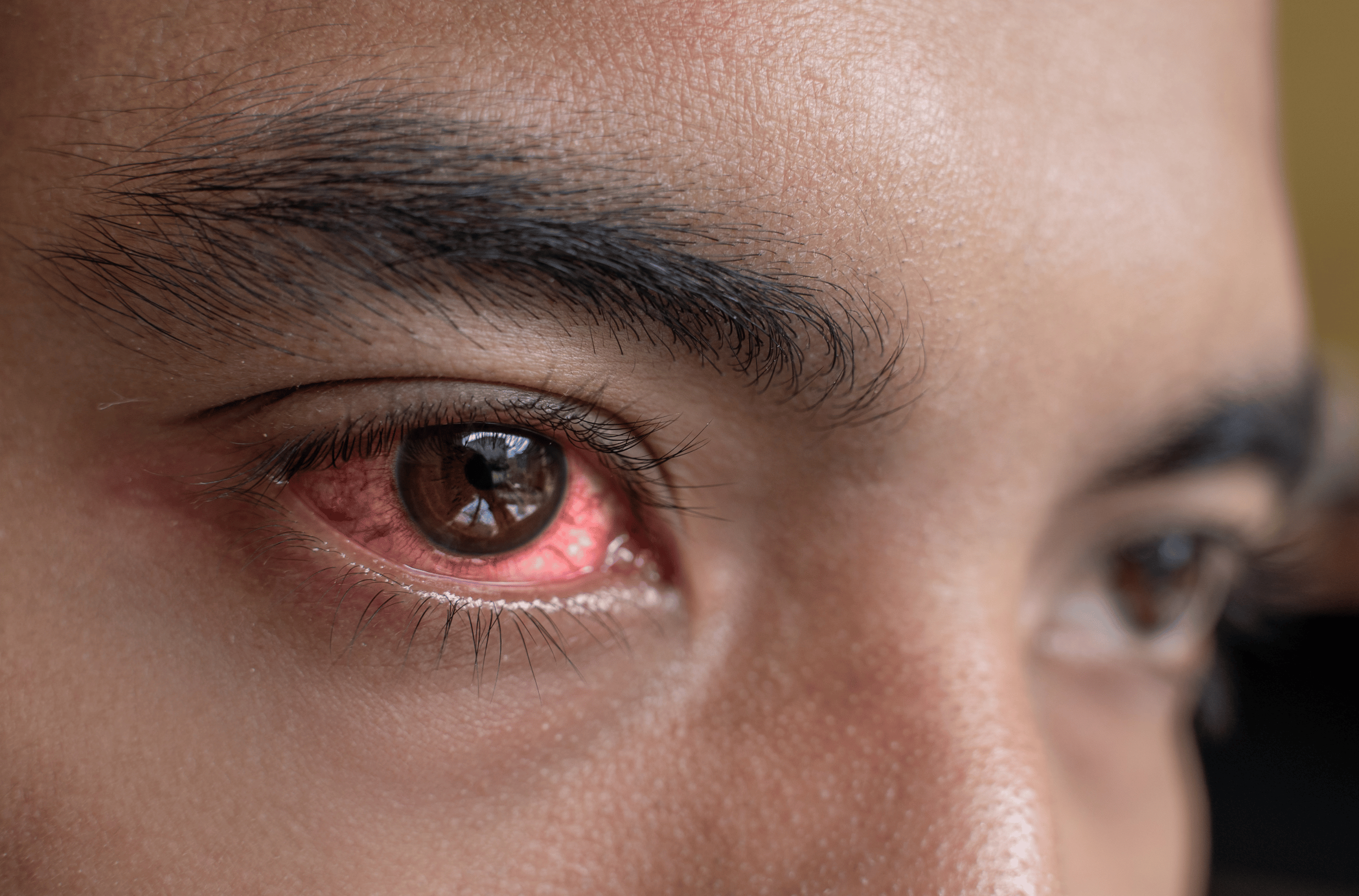 Illustration for Eye Infections treatment at Bellaire ER