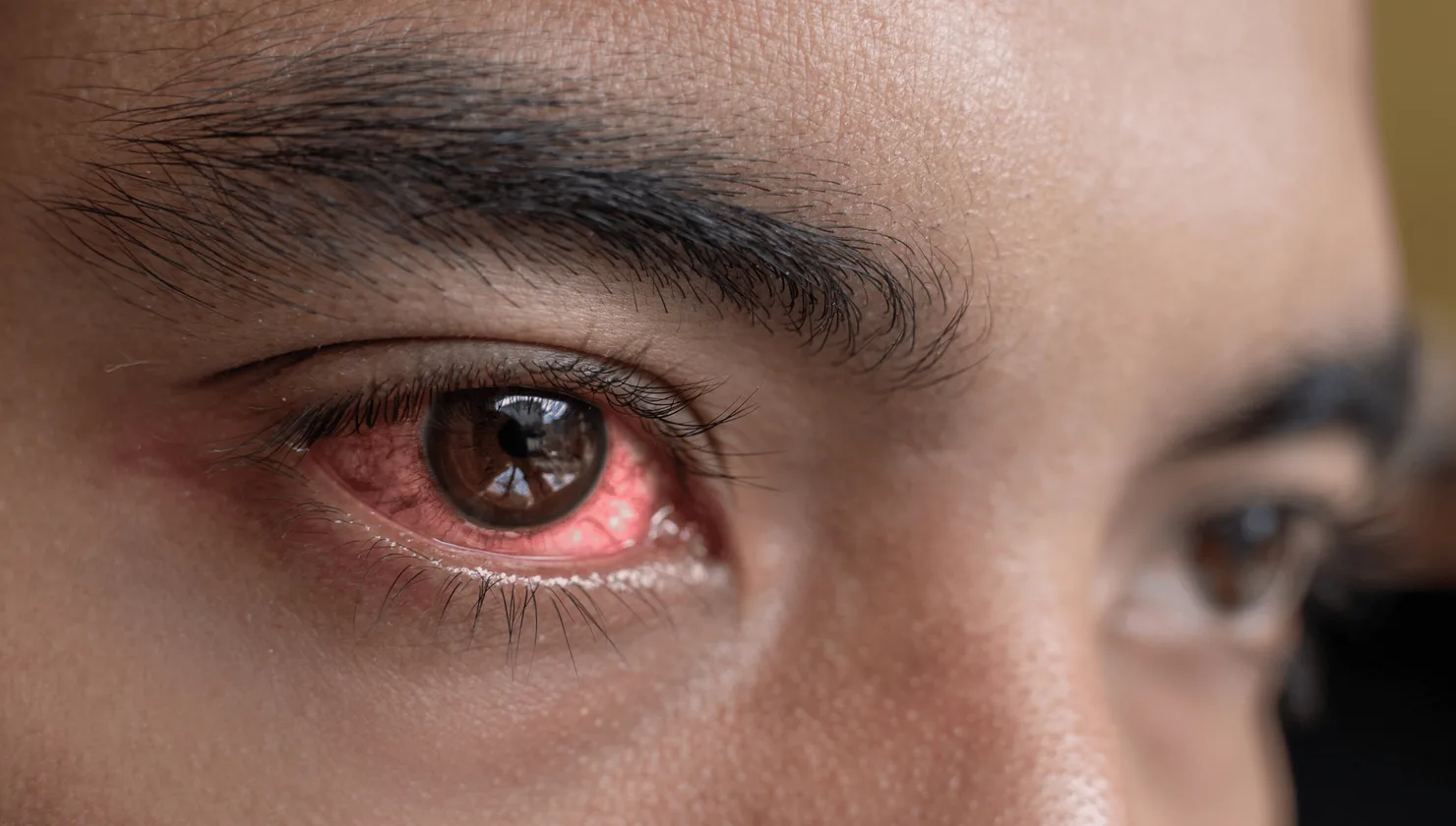Illustration for Eye Infections treatment at Bellaire ER