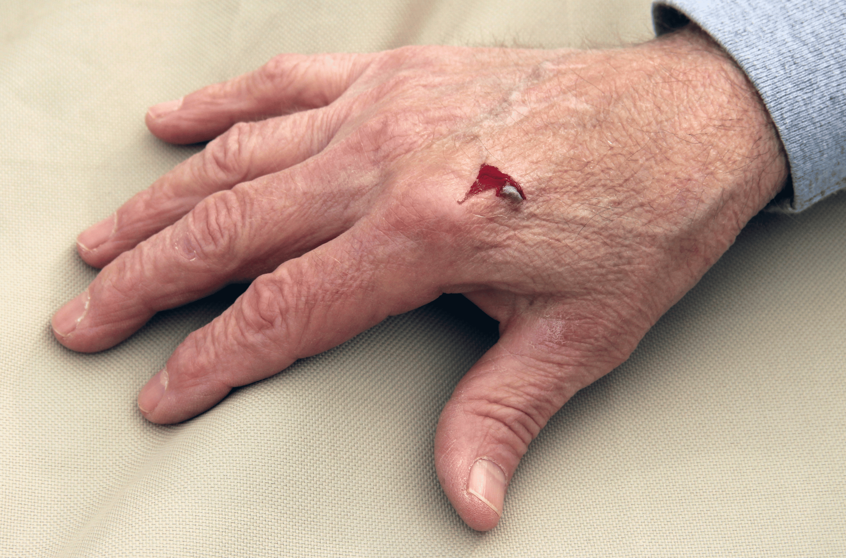 Illustration for Cuts and Lacerations treatment at Bellaire ER