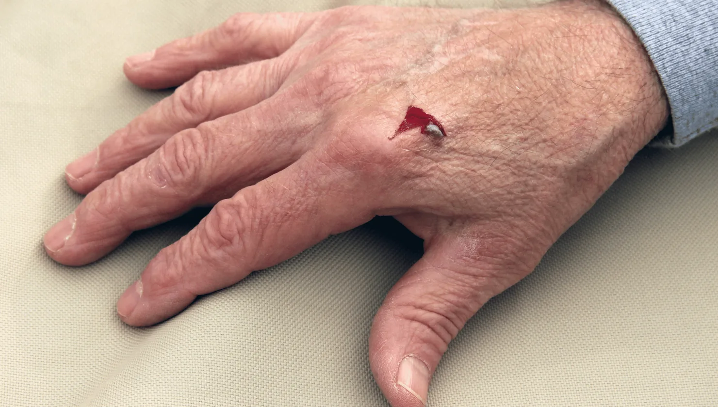 Illustration for Cuts and Lacerations treatment at Bellaire ER