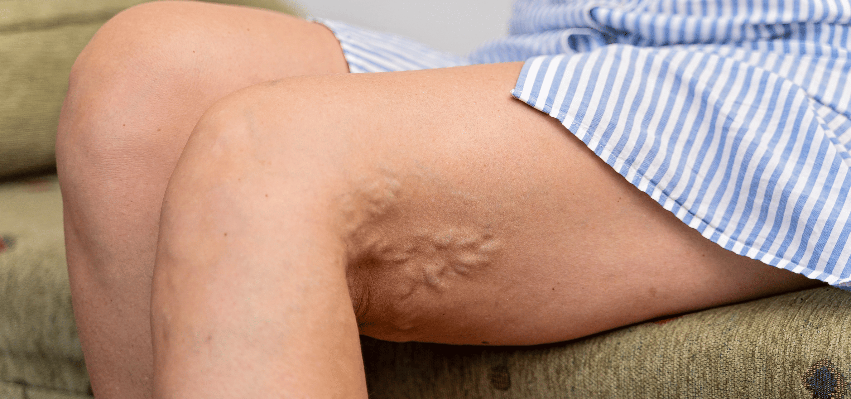 Illustration for Thrombophlebitis treatment at Bellaire ER