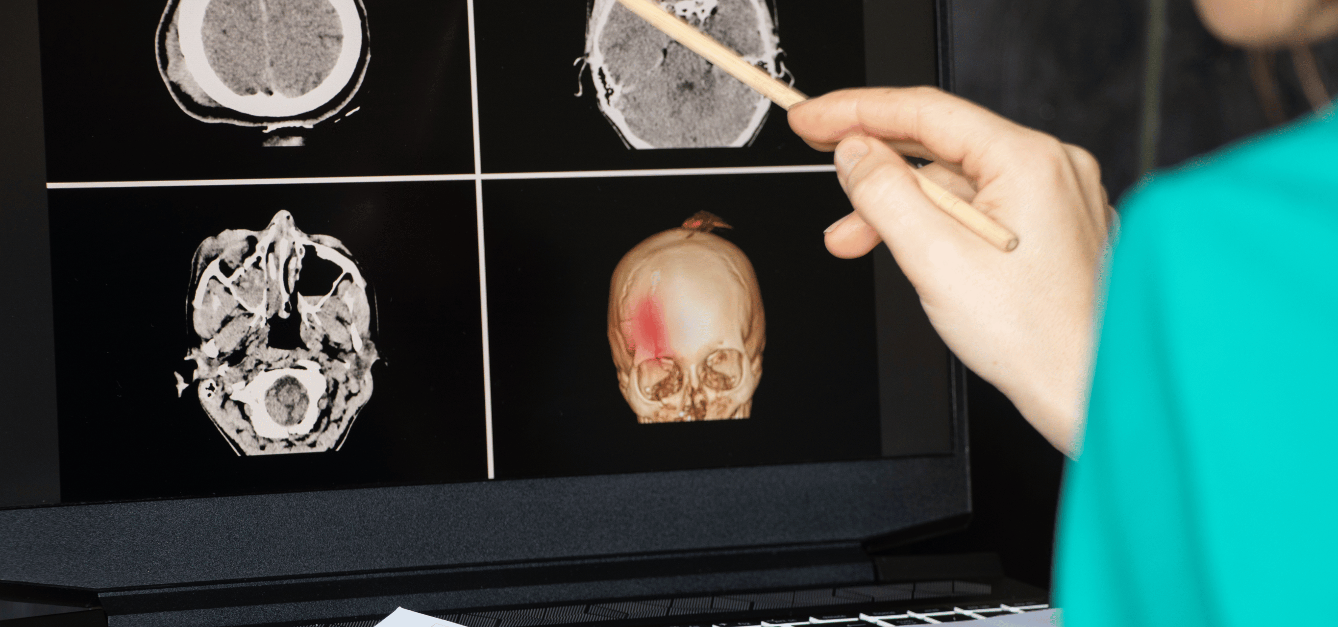 Illustration for Skull and Face Fractures treatment at Bellaire ER