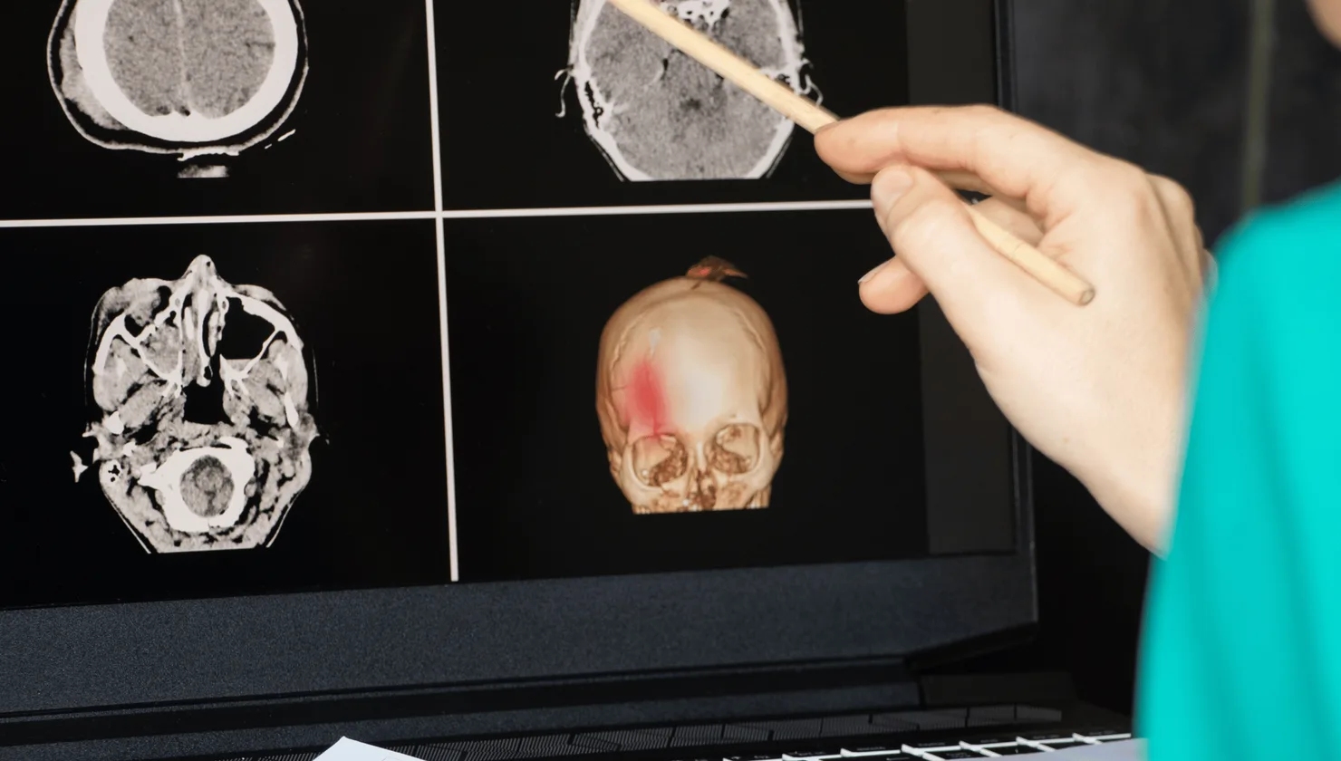 Illustration for Skull and Face Fractures treatment at Bellaire ER
