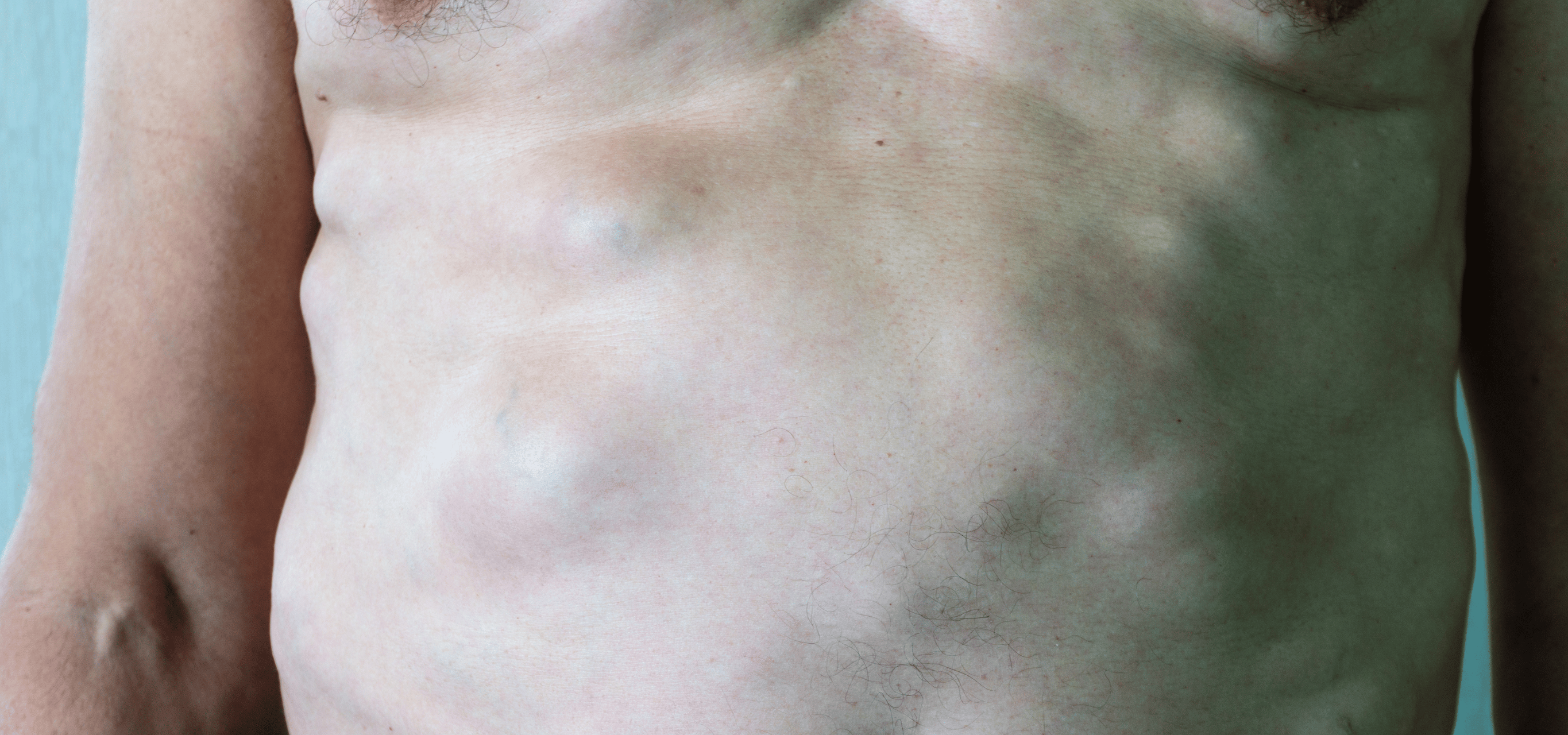 Illustration for Appendiceal Conditions treatment at Bellaire ER