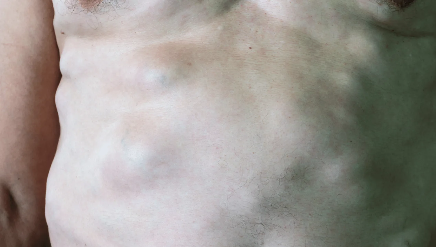 Illustration for Appendiceal Conditions treatment at Bellaire ER